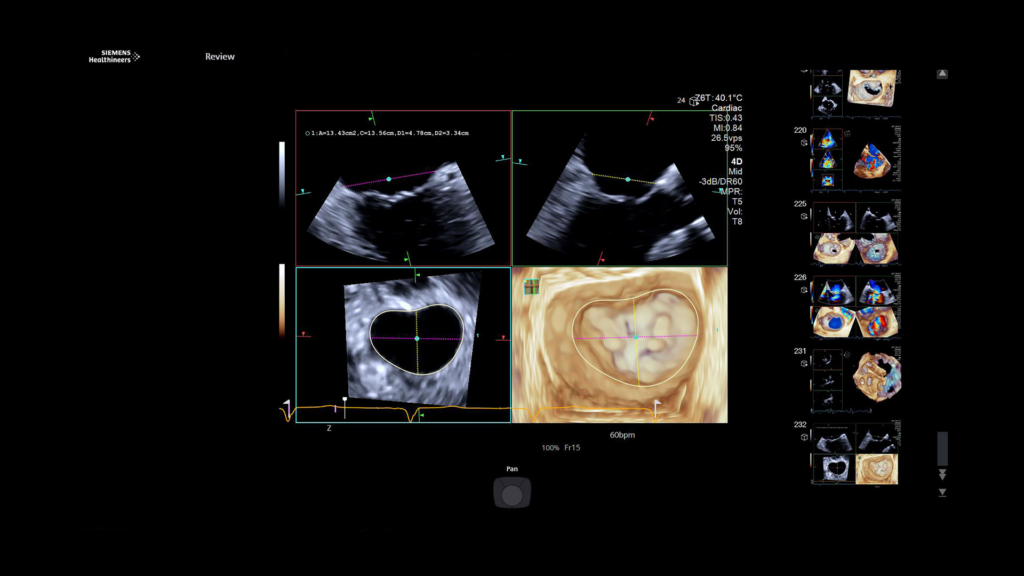 Smart1-siemens-healthineers-us-acuson-origin-trace-ai-16x9