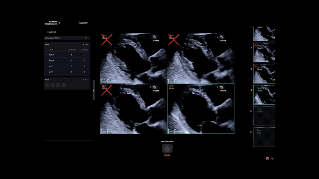 easy4-siemens-healthineers-us-acuson-origin-stress-echo-clinical-image